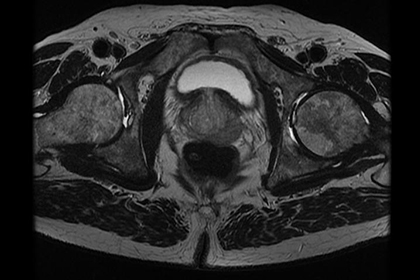 MRI of male pelvic organs