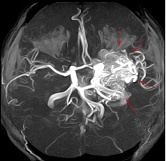 MRI of arteries and veins